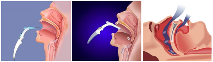 ENT Specialist Doctor In Mumbai Screenshot 2020 12 07 Snoring Treatment in mumbai Best Snoring Clinic